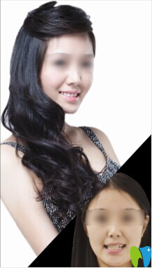 南昌德亞仿生冠美牙案例