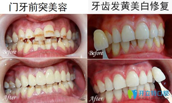 惠州致美口腔馬文智牙齒美學修復案例