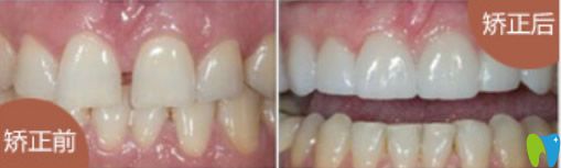 牙列稀疏、牙齒歪等矯正后效果對(duì)比圖