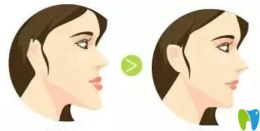 地包天如何預(yù)防？治療時(shí)間是什么時(shí)候？
