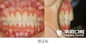 在濰坊華貝口腔做了牙齒矯正，恢復(fù)后我擺脫了齙牙妹