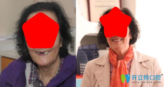 張煒院長為門牙缺失的患者種植牙案例