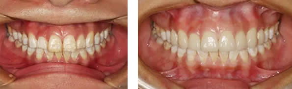 氟斑牙怎么美白 佛山華美口腔瓷貼面修復很管用 但價格稍貴