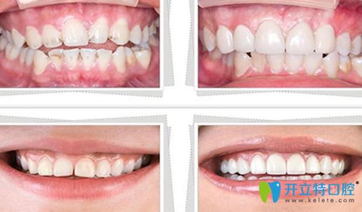 去西妃口腔做牙貼面治療前后案例對(duì)比圖
