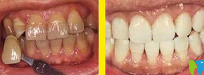 四環(huán)素牙如何變白？看牙齒變白簡(jiǎn)單有效的偏方大全