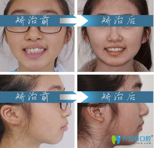 許楨睿門牙前突，牙齒不齊矯正案例前后正面、側(cè)面對(duì)不圖