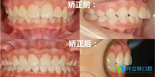 齙牙矯正后對(duì)比效果圖