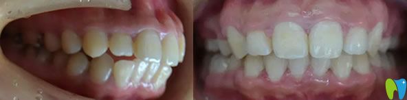 龍學(xué)輝主任齙牙矯正代表案例效果對比圖