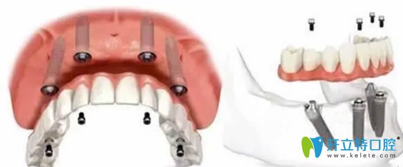 解析全口重建需要多少錢？價(jià)格和假牙為什么相差這么大