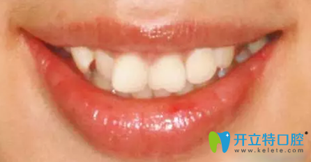 去<!--<i data=20240703-sp></i>-->美萊口腔做牙齒矯正前