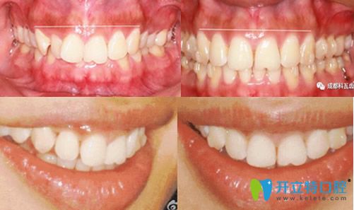 <!--<i data=20240703-sp></i>-->美萊口腔隱形矯正牙齒前后對(duì)比圖