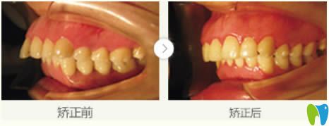 齙牙矯正案例及前后對比照 齙牙矯正案例及前后對比照