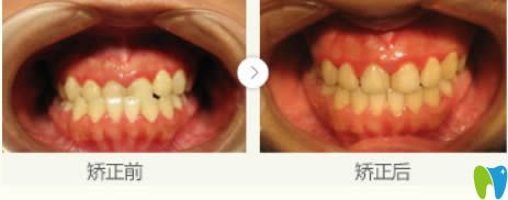 青少年地包天矯正案例及前后對比效果 青少年地包天矯正案例及前后對比效果
