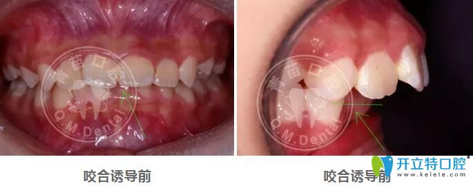 兒童咬合誘導哪家好？深圳青苗口腔羅慕咬合矯正案例驗證