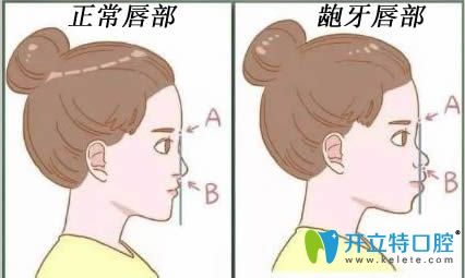 怎么區(qū)分齒性齙牙和骨性齙牙?哪個(gè)容易矯正?附相應(yīng)正畸方法