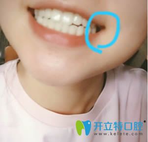 泉州維樂口腔牙齒種植真人案例效果圖