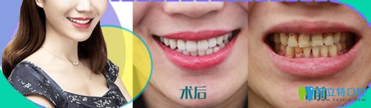 瓷貼面做了后悔死了，后悔沒有早點選擇華美牙科修復(fù)我的四環(huán)素牙
