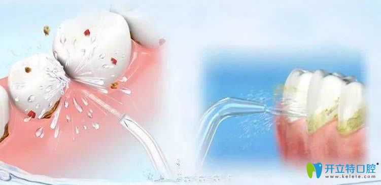 網(wǎng)傳洗牙后我得了艾滋病,都千萬別洗牙,揭秘洗牙的利弊真相