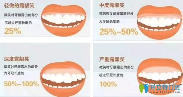 露齦笑可以矯正嗎？公布露齦笑手術(shù)費(fèi)用及矯正前后對比照