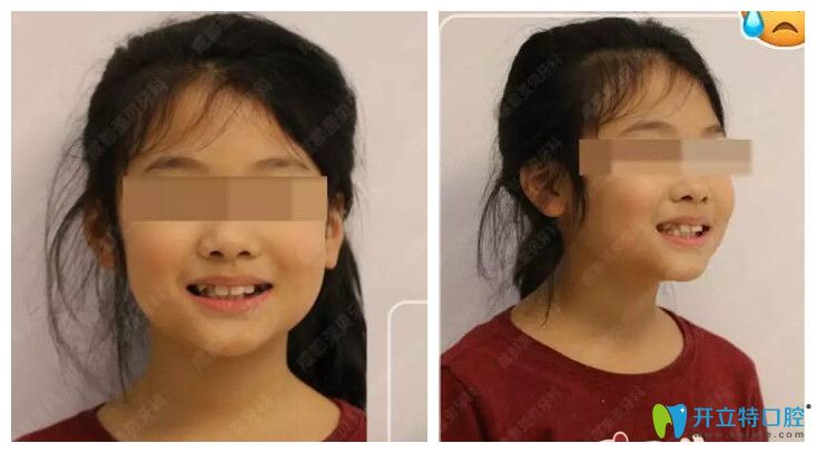 小孩輕微齙牙、個(gè)別牙反頜在成都圣貝口腔做正畸案例效果