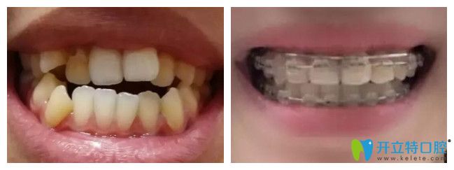 重慶團(tuán)圓口腔張亞醫(yī)生陶瓷托槽矯正案例