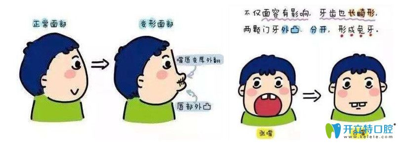 牙為什么越來越往外突，我該如何防止牙越來越外突