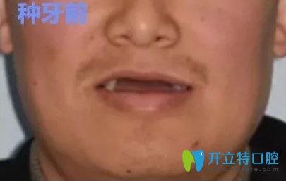 你對(duì)韓國(guó)牙科的水平和價(jià)格還有疑問(wèn)?看下他們的種植牙體驗(yàn)