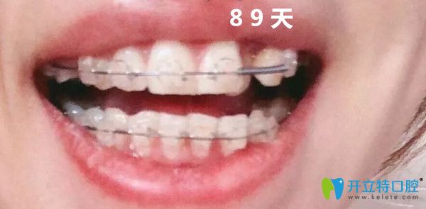 正畸第三個(gè)月變化圖