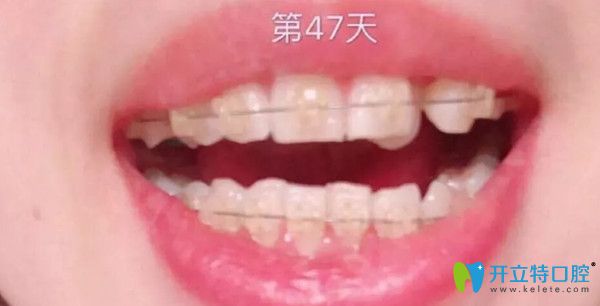 陶瓷托槽矯正第1個(gè)月