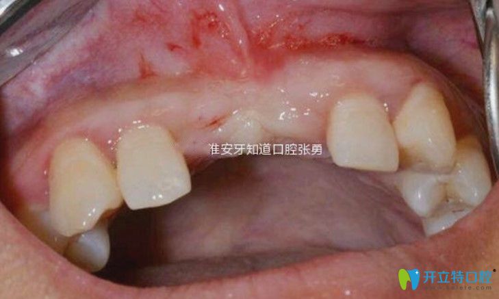 淮安哪里做種植牙好？顧客反饋淮安牙知道張勇種牙水平高