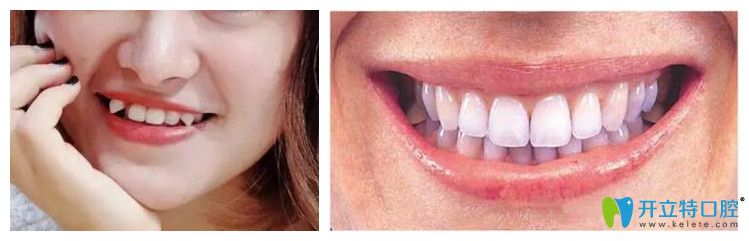 天津愛齒口腔虎牙矯正