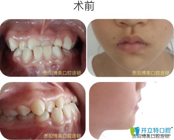 哇塞!戴陶瓷自鎖牙套才17個(gè)月就矯正了我前牙反頜+牙列不齊