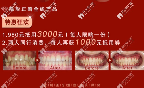 想在溫州做正畸?不妨了解下藝星開(kāi)展的在家矯正牙齒的方法