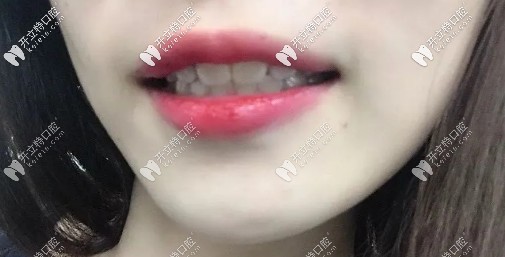 矯正后的效果圖，略微有點(diǎn)內(nèi)頃