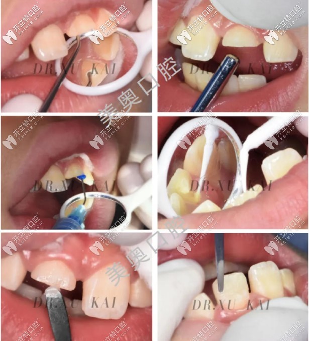 兒童根尖誘導(dǎo)+根管填充治療 兒童根尖誘導(dǎo)+根管填充治療
