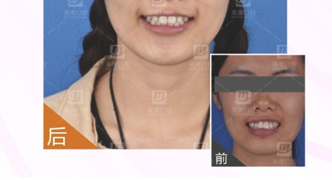 重慶美奧口腔成年地包天可以矯正嗎?閃現(xiàn)一波20歲地包天和齙牙整牙案例