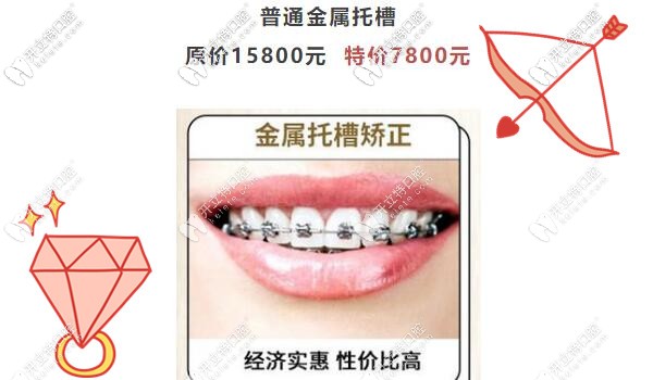 廣州圣貝傳統(tǒng)金屬托槽矯正才7800元啦,暑假正畸不造起來嗎？