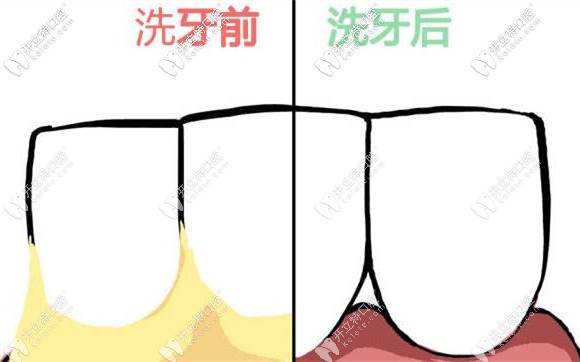 要定期進(jìn)行洗牙