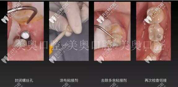 無(wú)錫美奧口腔單顆牙冠佩戴