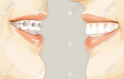 深挖mbt直絲弓矯正技術(shù)費(fèi)用很貴嗎?矯牙戴它好嗎