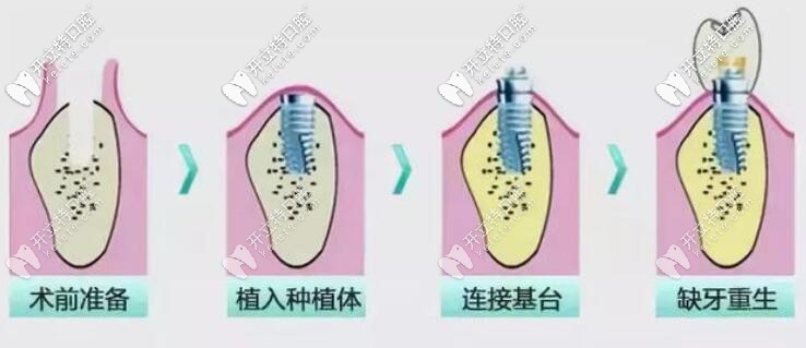 種植牙過程