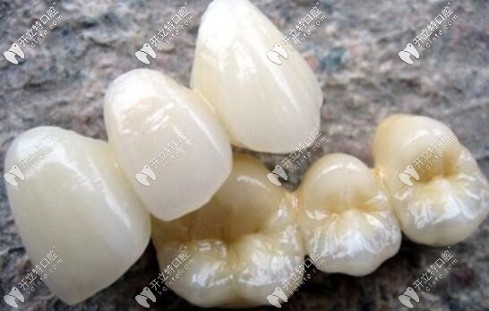 二氧化鋯全瓷牙 二氧化鋯全瓷牙