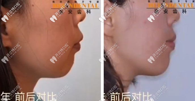 看呆！凸嘴少女在惠安齒科戴自鎖托槽矯正半年后…