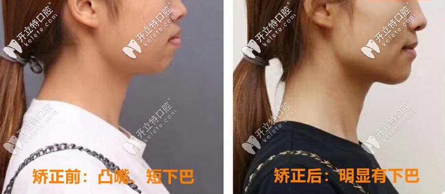 矯正前后對比照片：明顯有下巴，側顏好看