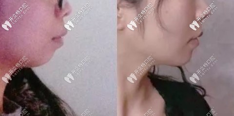 骨性正畸一般收幾毫米?牙齒內(nèi)收3-7mm側(cè)臉效果對比變化大嗎?