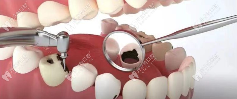 蛀牙不嚴(yán)重為什么要及時(shí)補(bǔ)牙，窩溝齲黑線是否要補(bǔ)牙呢？