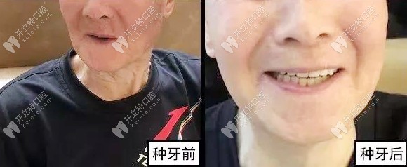 張叔叔種牙前后的效果圖