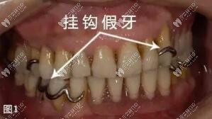 活動(dòng)義齒之漲知識:隱形假牙和帶鉤子假牙的區(qū)別原來有這些